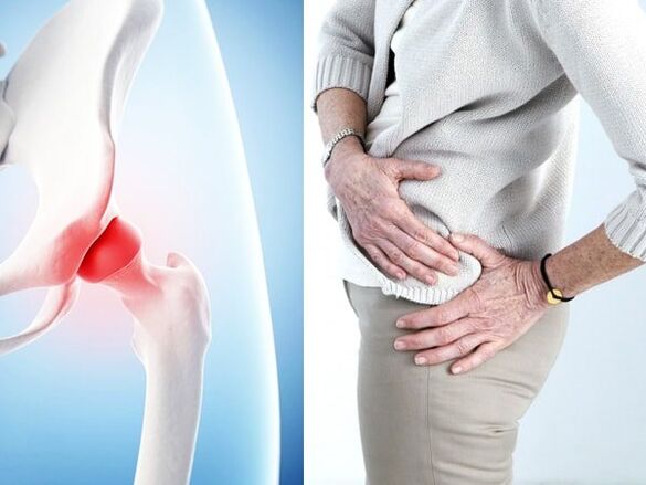 symptoms of hip arthrosis