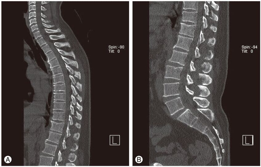 Deformation of intervertebral discs on MRI images in thoracic osteochondrosis
