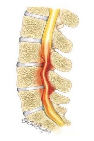 In osteochondrosis of the thoracic spine, compression of the spinal canal occurs