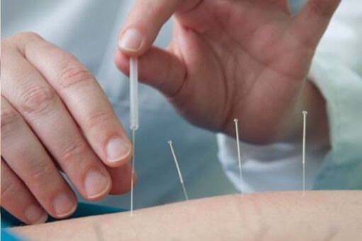 Acupuncture - a method of treating pain in the lumbar region caused by osteochondrosis