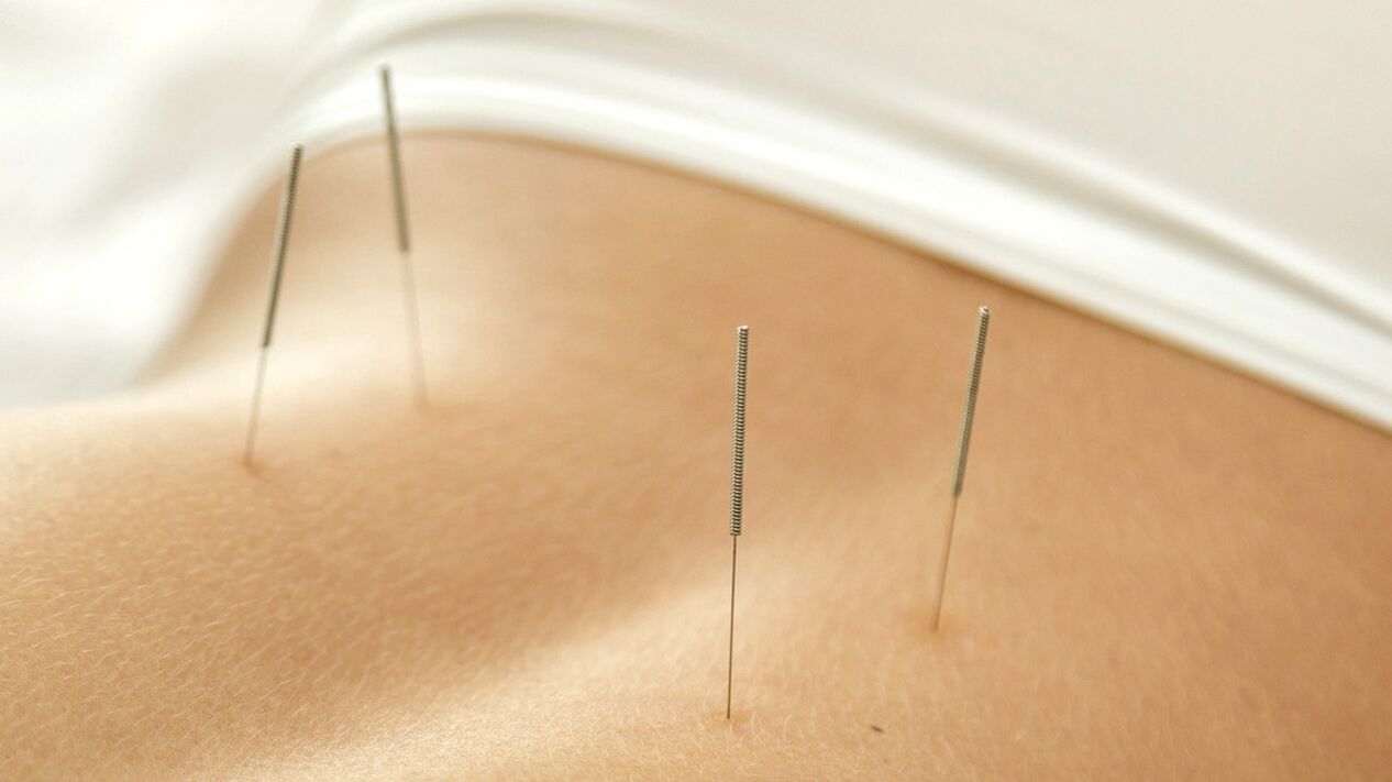 Acupuncture will help you get rid of lower back pain